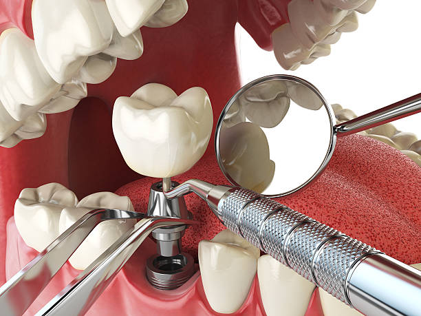 Best Emergency Dentist for Lost Fillings or Crowns in Brawley, CA
